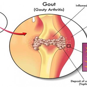3 cách chữa bệnh gout hiệu quả