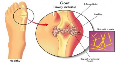 3 cách chữa bệnh gout hiệu quả