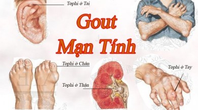 Điều trị bệnh Gout